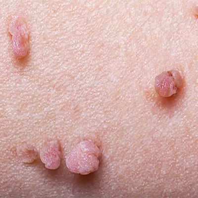 Verruga de piel común